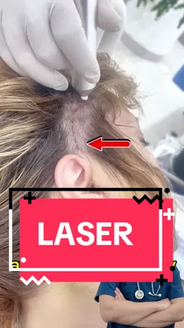 After facelift surgery, laser treatment to improve results and minimize scars and dark spots #hottrend #surgery #videoviral #tiktokviral #facelift #necklift #nose #body 