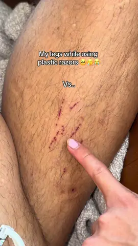 How do you get rid of hair? This safety razor discovery helped me so much!! I got rid of ingrown hair and razor cuts in a month. Did anyone else try it? #shaving #shavingroutine #shavingtips #shavinghacks #fyp 