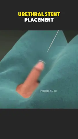 Urethral Stent Placement (3D Animation) #urethralstent #ureteralstent #alliumbusstent #urethratreatment #blockedurethra #bphtreatment #beningprostatichyperplasia 