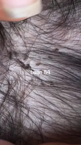 I will solve all the itching problems #lice #😱😱😱 #omg😱😱 #trending 
