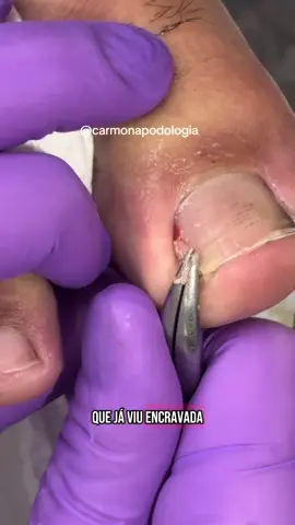 Unha encravada gigante! #unhas #foryou #podologia #forpageyou #fyp #unhaencravada #viraltiktok #tiktok #pes 