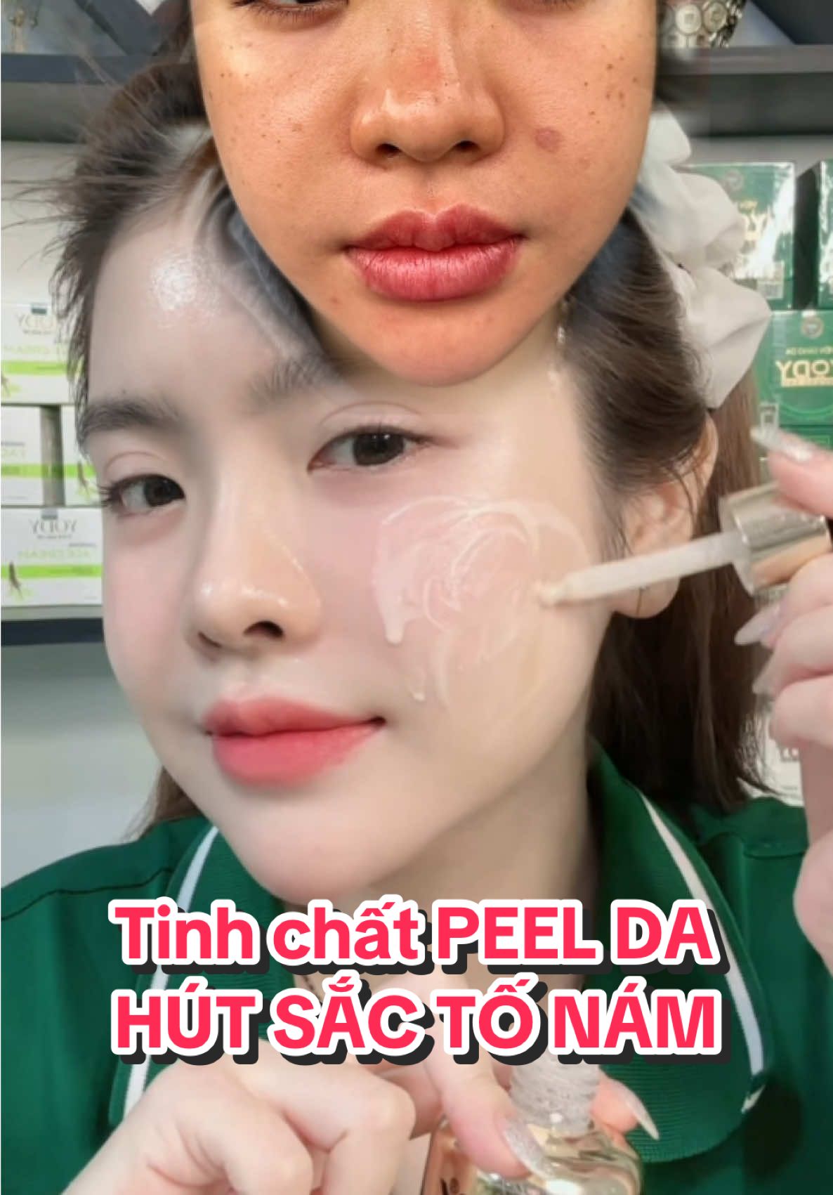 Tiinh chất PEEL DA HÚT SẮC TỐ NÁM
