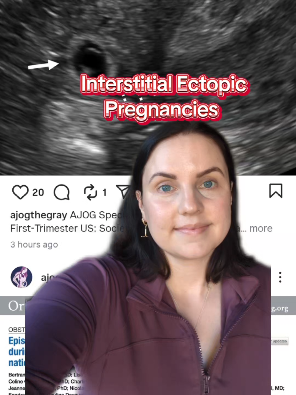 Interstitial Ectopic Pregnancies! These are very rare, accounting for 2-4% of all ectopic pregnancies. These will require an abortion as treatment, as the risk of morbidity and mortality is extremely high. Abortion care saves lives! These are a bit trickier to diagnose than the average ectopic pregnancy. So all the more reason why people who see a crisis pregnancy centre are actually putting themselves in danger by having untrained staff perform ultrasounds, and delaying diagnosis. Drop any questions below👇  #abortionMD #pregnancyloss #interstitialectopicpregnancy #ectopicpregnancy #abortion #abortionsaveslives
