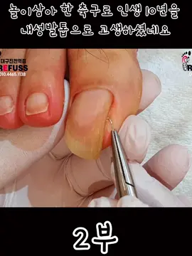 #viral #viralvideos #toenail #foryoupage❤️❤️ 
