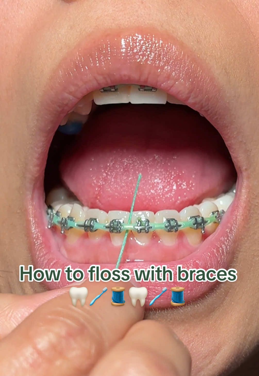 Part 3| HOW TO FLOSS WITH BRACES(SUPER FLOSS) 🧵🦷 #braces #adultbraces #oralb #bracesoff #bracestips #bracescheck #bracesjourney #orthodontist #ortho #flossing #dental #dentistry #bracescolors #dentalassistant #dentist #asmr #asmrsounds #asmrvideo 