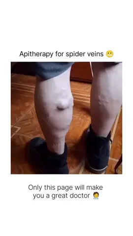 Bee Venom for Veins? 🐝🩸 Apitherapy, a natural treatment using bee venom, is believed to help reduce varicose and spider veins. Thanks to its anti-inflammatory properties, it may improve blood circulation, ease swelling, and even support vessel wall strength. Some say it can break down small clots and enhance skin appearance—naturally! 🌿✨ . . . . . #Apitherapy #BeeVenomTherapy #VaricoseVeins #NaturalHealing #SpiderVeins #CirculationBoost #BeePower