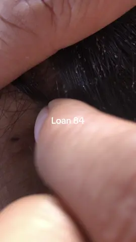 lice removal #lice #😱😱😱 #omg😱😱 #trending 
