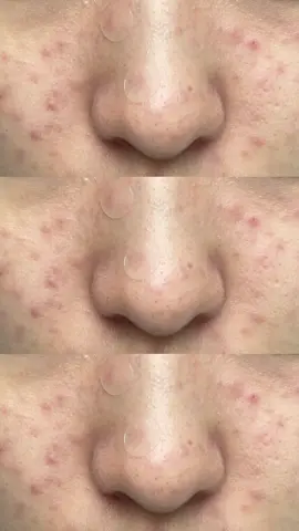 원래 피부에 여드름 하나없이 좋았는데 갑자기 이렇게 되어버렸어요 딱딱한 화농성여드름이 많은데 어떻게 해야하나요ㅠㅠㅠㅠ #화농성 #여드름 #좁쌀 #모공 #도와주세요ᅲᅲ 