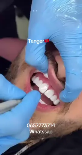 #les_facettes_composite #dentis #أسنان #عدسات_الاسنان  #tanger #tetouan #casa #agadir #rabat #maroc #marocaine🇲🇦 #maroco🇲🇦algeria🇩🇿tunisia🇹🇳 #المغرب #تجميل 