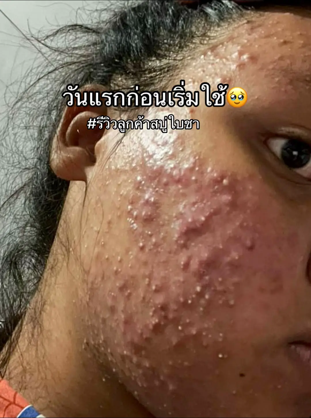 #สบู่ใบชา #สบู่ใบชาสูตรแพทย์แผนไทย #สบู่ใบชารักษาสิวหลัง #สบู่ใบชารักษาสิว #สเปรย์ใบชา #สเปรย์ใบชารักษาสิวหลัง #สเปรย์ใบชารักษาสิว #สเปรย์ใบชารักษาโรคผิวหนัง #สบู่รักษาสิวหลัง #รักษาสิวหลัง #สิวหน้าอก #สิวหลัง #สิวที่คอ #สิวคอ #สิวที่ก้น  #สิวก้น #สิวหลังใช้ไรดีถึงหาย🤣 #เซรั่มใบชา  #เซรั่มใบชาสูตรแพทย์แผนไทย  