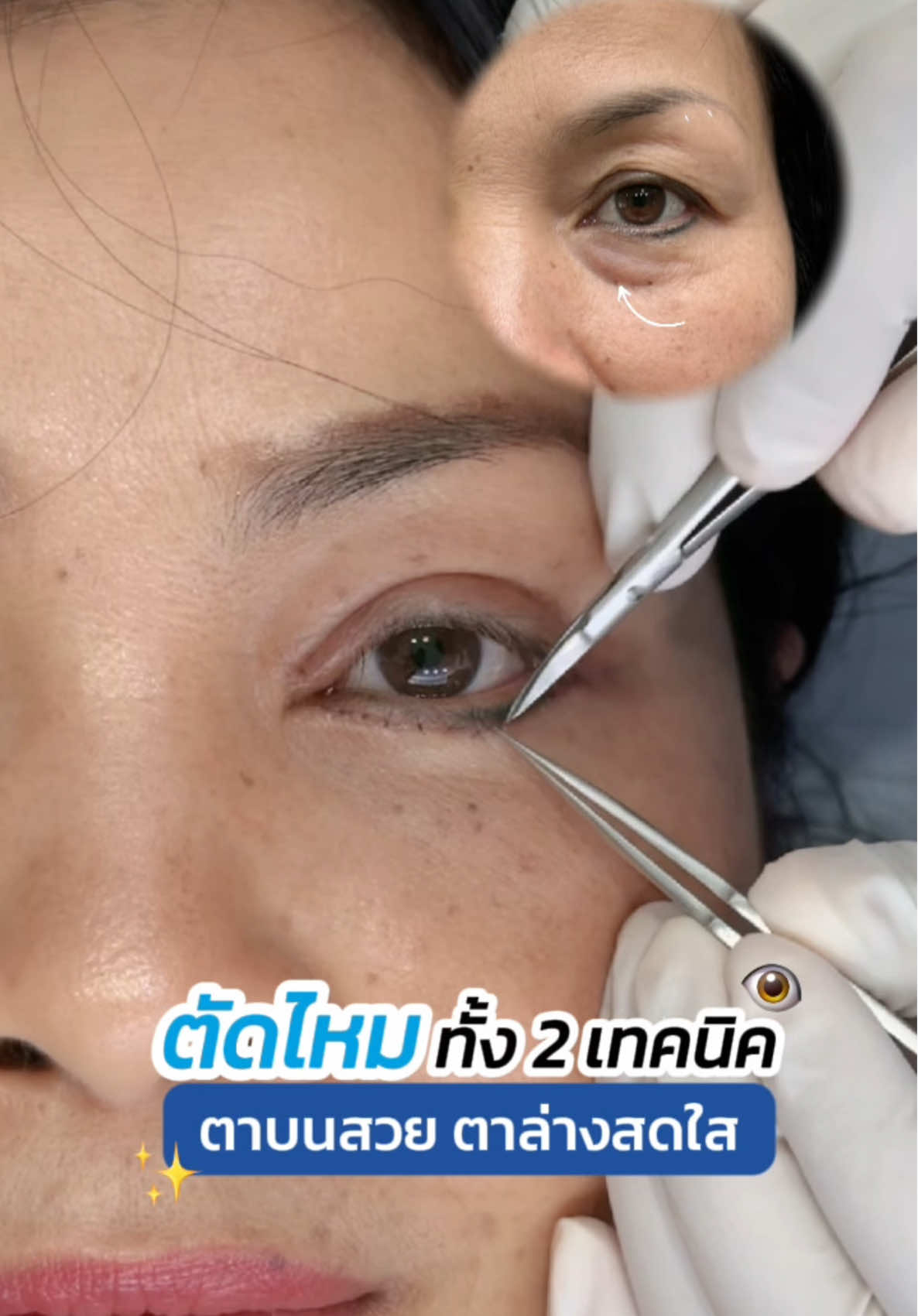 ตัดไหมทำตาบน-ล่าง 2 เทคนิค ✨👁️ #รีวิวกำจัดถุงใต้ตา #รีวิวตาสองชั้น #skyclinic #หมอสกาย #จักษุแพทย์ #ทำตาที่ไหนดี #สกายคลินิก #ศัลยกรรมตา #babylock 