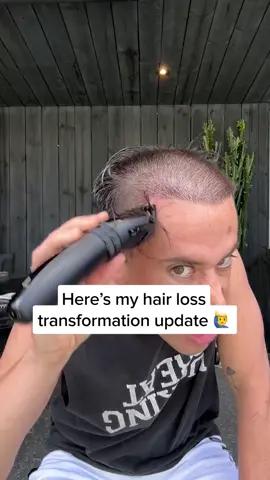 💇‍♂️ Hair loss? Tried it all? Same. Pills, oils, magic shampoos… all cap. 😤 But What about this?  Introducing “AlphaInfuse” —  With all new Micro needling system, the only thing that actually worked for me. ✨ 70% OFF right now (while supplies last) + 120-day money-back guarantee. Your scalp’s waiting. Don’t. 🚀 #hairloss #hairlosssolutions #hairlossjourney #beforeandafter #hairtransformation 