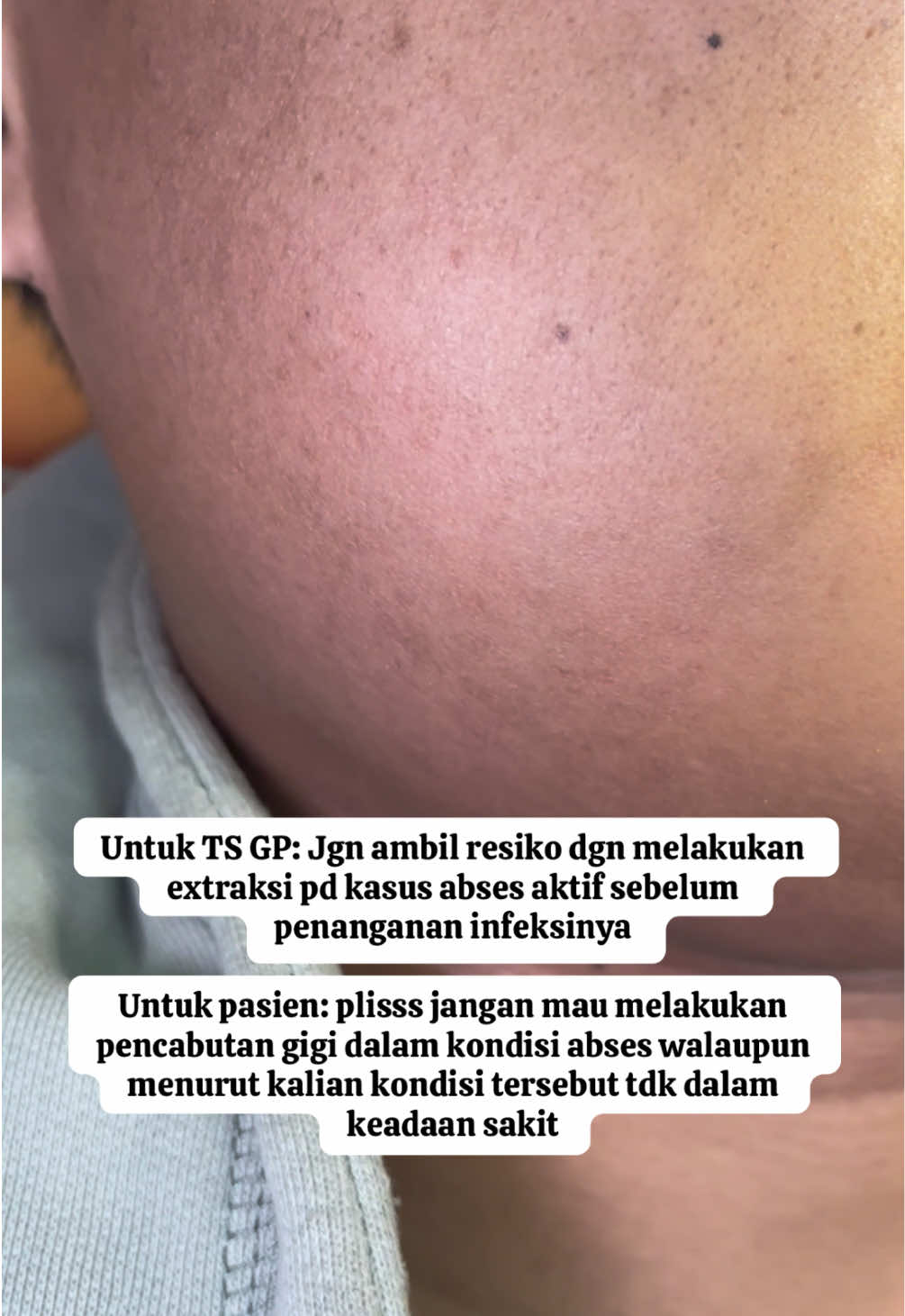 Penanganan abses BUKAN dengan cabut gigi, TAPI mengatasi infeksinya terlebih dahulu dgn pemberian obat2an/membuat sayatan tuk mengeluarkan nanah penyebab infeksinya. #dentistlife #cabutgigi #fyp #masukberanda 