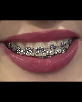 انا الوحيدة؟  #داهينا #داهينا_كاتس #داهينا_كاتس🖤❕ #تقويم_الاسنان #الم 