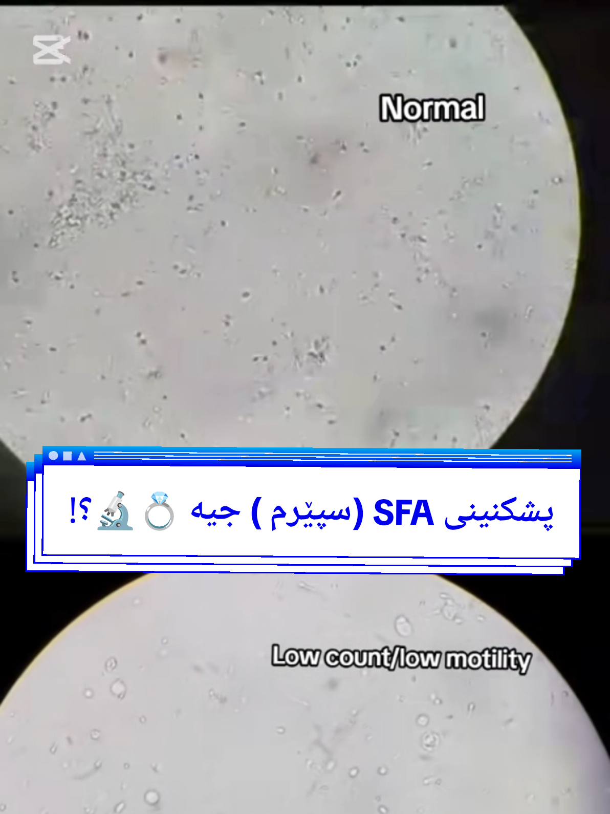 پشکنینی سپیرم جیە  لەج کاتیک دەکریت  بۆ ج مەبەستیک دەکریت! #spearmint #morphology #motility #accont #active #dead 
