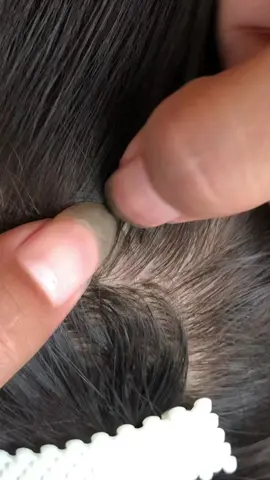 😱😱😱#omg #lice #liceremoval 