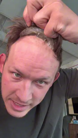 START NOW trust me when I say this!! When it’s too late it’s too late!! #hairgrowthtips #hairgrowth #recedinghairline #hairgrowthjourney #rosemary #tiktokshopcreatorpicks 