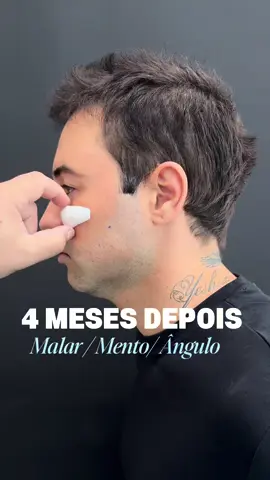 Resultado definitivo do Rafael com 4 meses de pós operatório.  Sendo utilizado implantes de polietileno poroso de alta densidade.  #drjorgefernandes #implantesfaciais 