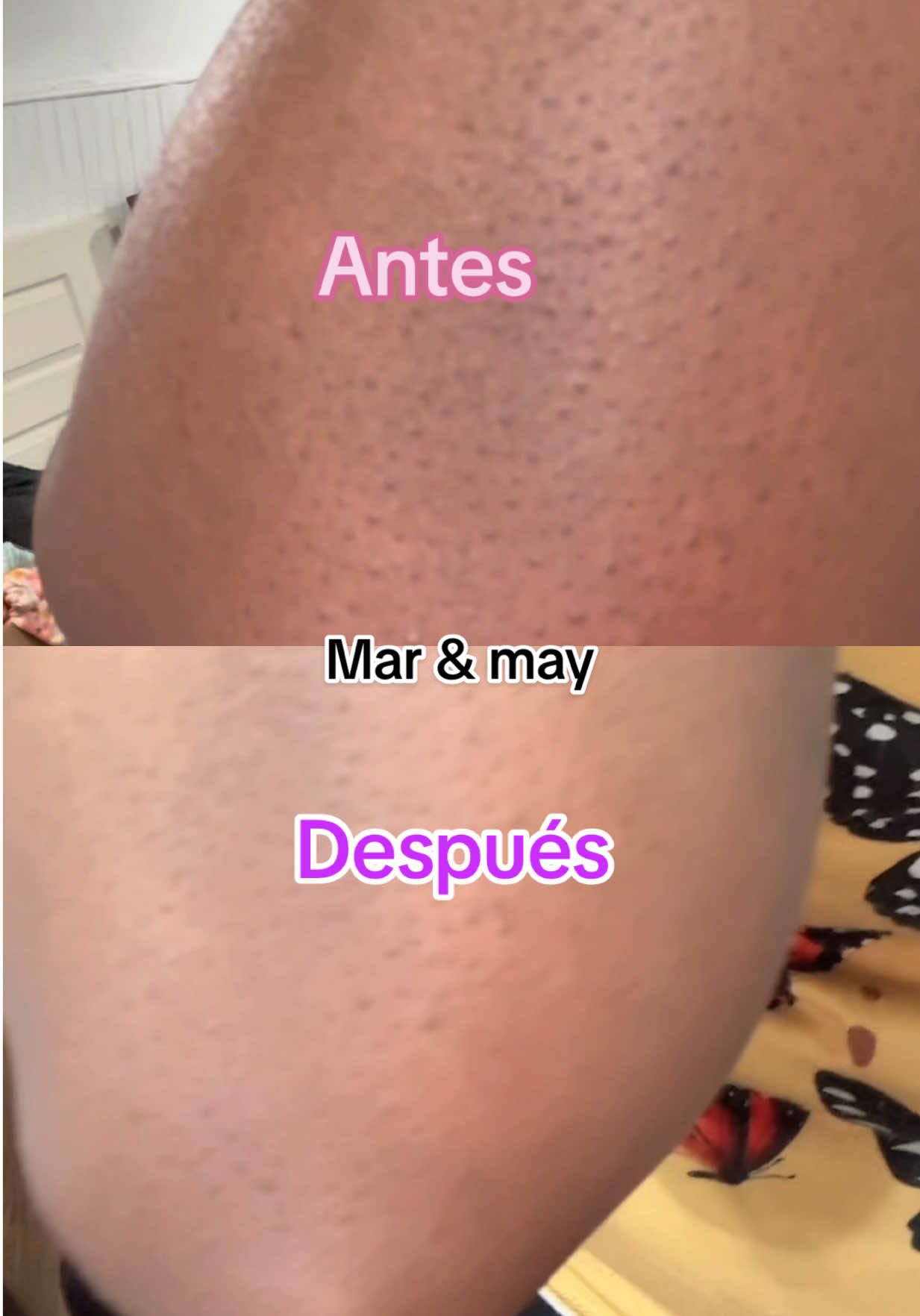 Resultados reales en 15 días con @Mary&May Official @Mary&May MY @LATAM_OFICIAL🔥 #koreanskincare #skincareroutine #usa #foryou #belleza #skincare 