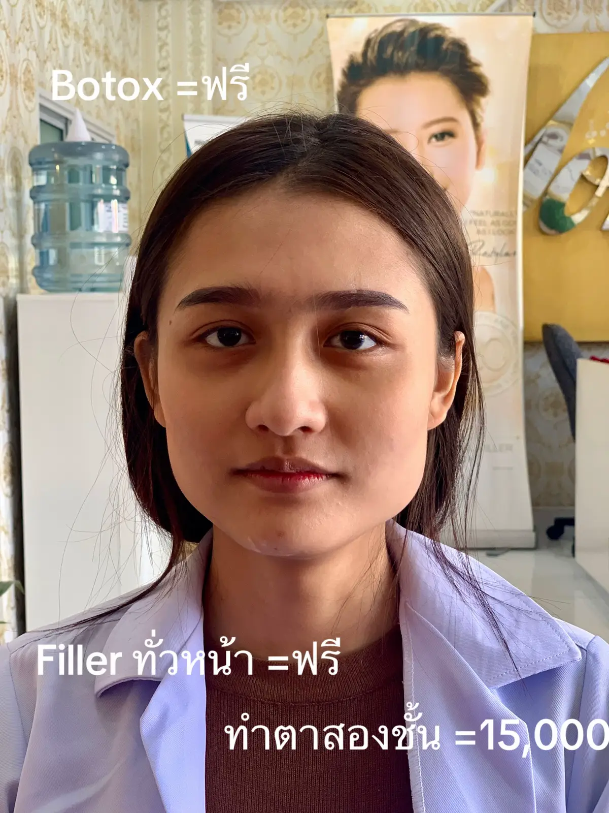 พัฒนาตัวเอง😂#สวยพุ่งจนต้องแชร์ #ฉีดหน้าเด็ก #filler  #รีวิวหัตถการที่ทํา #ปรับรูปหน้า @kyssclinic 