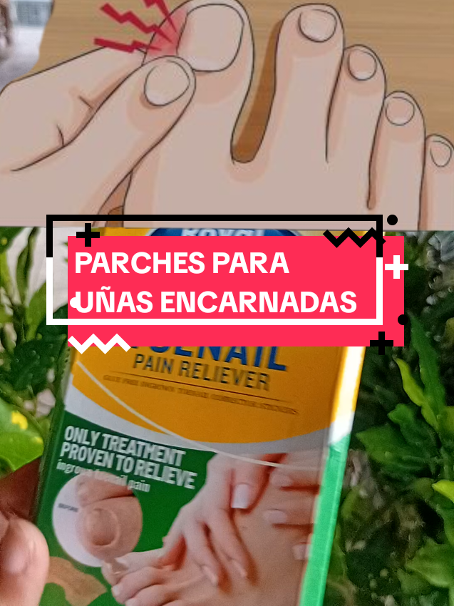 parches para aliviar el dolor  de uñas encarnadas. paquete contiene 20 piezas, prácticos y fáciles de usar.#uñasencarnadas  #tratamientosparauñasencarnadas  #parchesparauñasencarnadas 