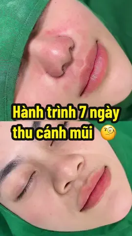 Thu cánh mũi liệu có sẹo hay không. Theo dõi mới biết được. #thucanh 