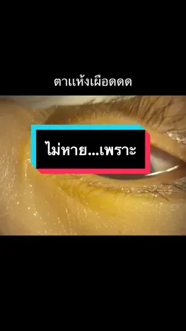 #ต้อกระจก #iclหมอสารี #เลสิกหมอสารี่ #scleralenses #relexsmile #lidspa #สปาตา 