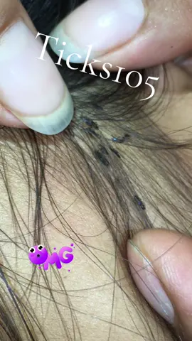 Remove lice #😱😱😱omg #😭😭😭 #liceremoval #🥶🥶🥶 #like 