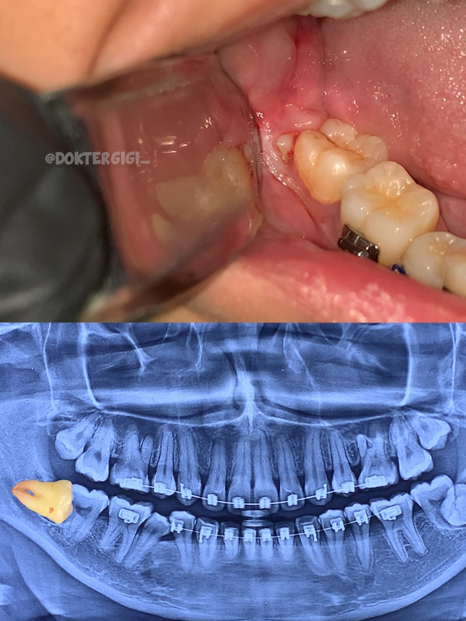 WARNING! This video may contain disturbing scenes/images. It’s intended as health education. #odontectomy #gigibungsu #doktergigibekasi #doktergigimedan #doktergigimakassar #doktergigijakarta 