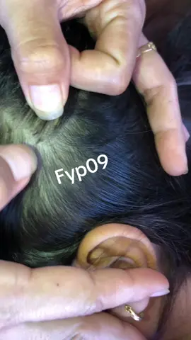 #omg😭 #lice #removelice #🥹 #fyp #relatable 
