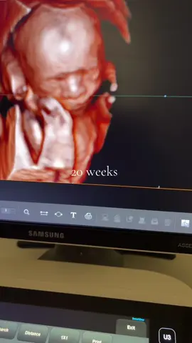 Did you know you can see baby’s face features at 20 weeks? 👶🏻☺️🩷 #baby #ultrasound #sonographer #pregnancy #pregnant #cutebaby #hdultrasound 