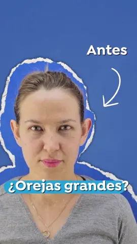 👂✨ Resalta tu perfil, recupera tu confianza La otoplastia es el procedimiento que corrige la forma, tamaño o proyección de las orejas, logrando un aspecto más armónico y natural. En este antes y después, verás cómo un pequeño cambio puede marcar una gran diferencia en la seguridad y autoestima de nuestros pacientes. 💬 ¿Sabías que la recuperación es rápida y los resultados permanentes? Cuéntanos… ¿te animarías a este procedimiento? #otoplastia #orejasgrandes #simetriafacial #saludybelleza #GlowUp 