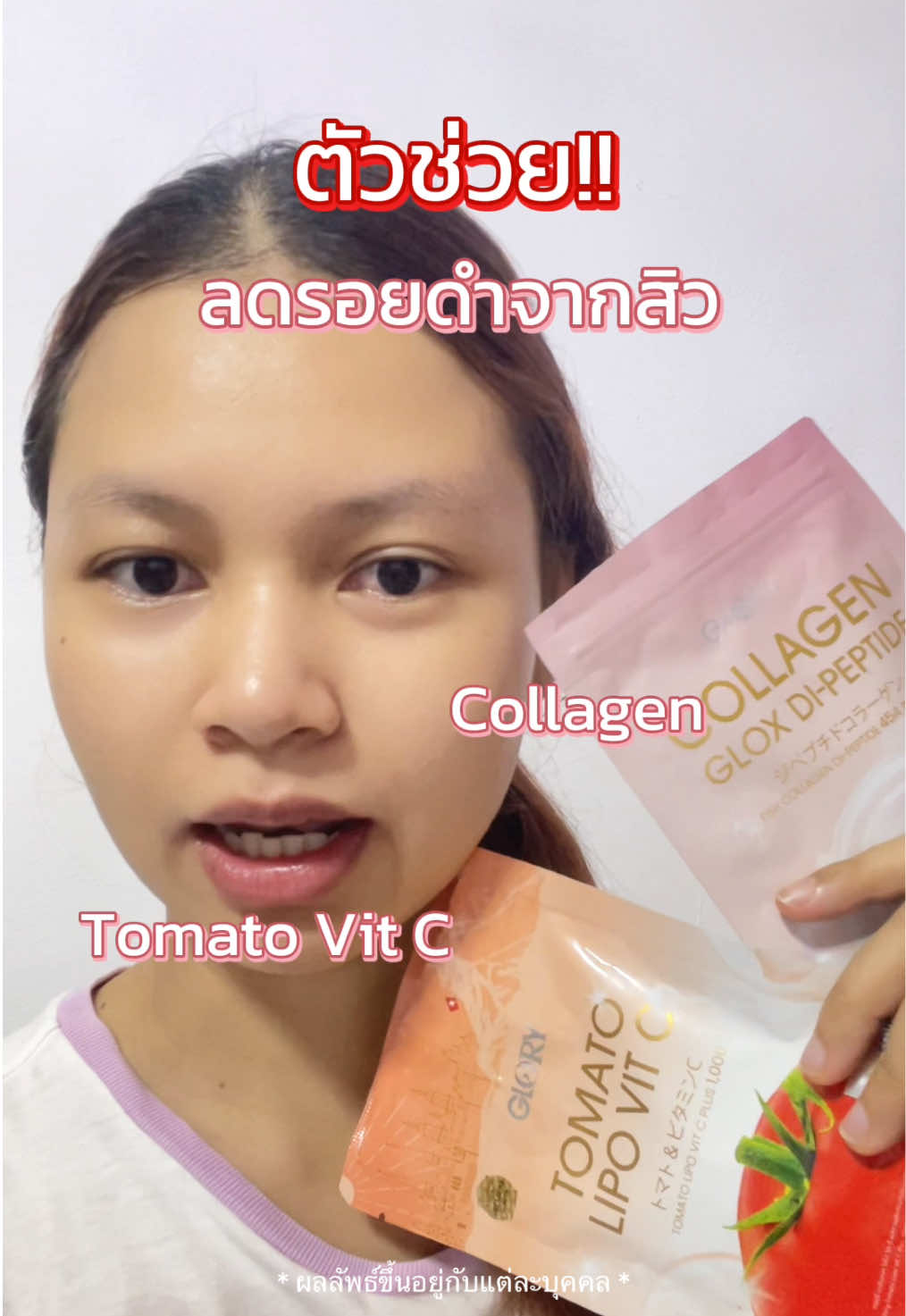 ตัวช่วยลดรอยดำจากสิว ด้วยกลอรี่คอลลาเจนและมะเขือเทศอัดเม็ด ✨🩷 #กลอรี่คอลลาเจนแม็กซ์โดส  #กลอรี่คอลลาเจน1maxdoseเท่ากับ1drip  #กลอรี่คอลลาเจนเกรดพรีเมี่ยมเข้มข้น30เท่า  #Glorycollagen  #วิตามินตัวดังtiktok 