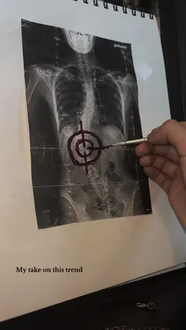 Fuck scoliosis #fyp #real #scoliosis #trend @✰ 
