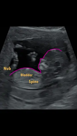 He or She? The link to the gender prediction app is in my profile 🩷💙 #nubtheory #genderreveal #genderscan #nubxapp