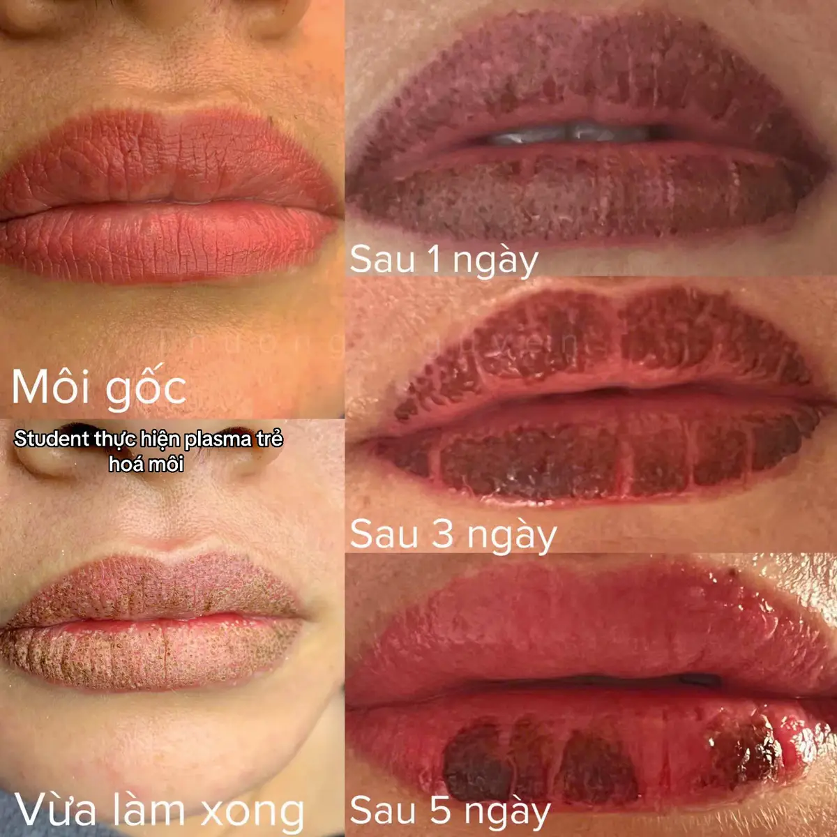 Plasma trẻ hoá môi xỉn màu bết thực ❤️