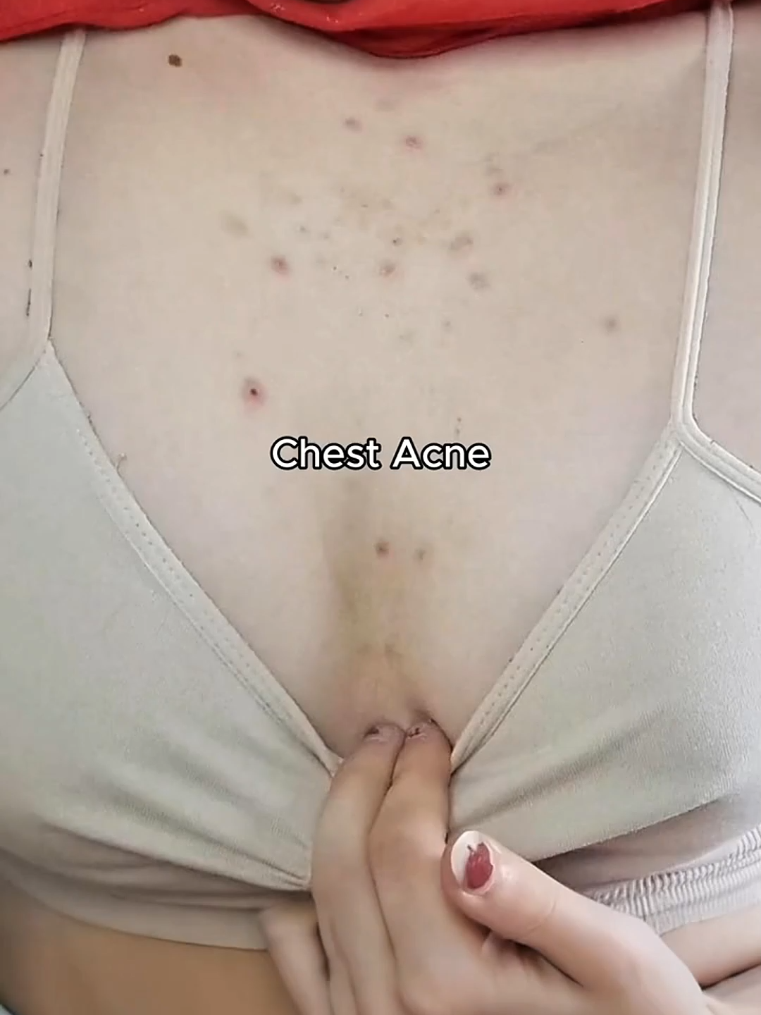clear chest, clear back.YES!!! #bodycare #acnetreatment #skinever #skineverph @skinever_philippines