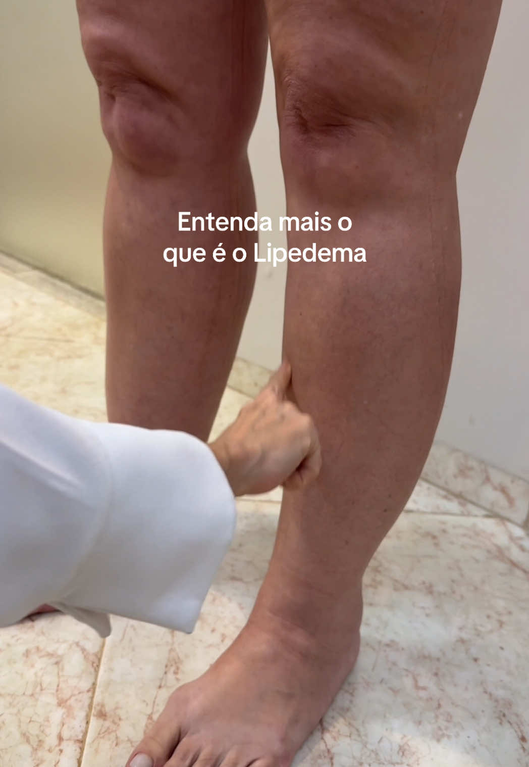 #creatorsearchinsights gordura desproporcional nas pernas ou braços, dor, inchaço e muita dificuldade de emagrecer!  Isso é Lipedema, uma doença que não tem cura e afeta milhares de mulheres pelo mundo.  #lipedema 