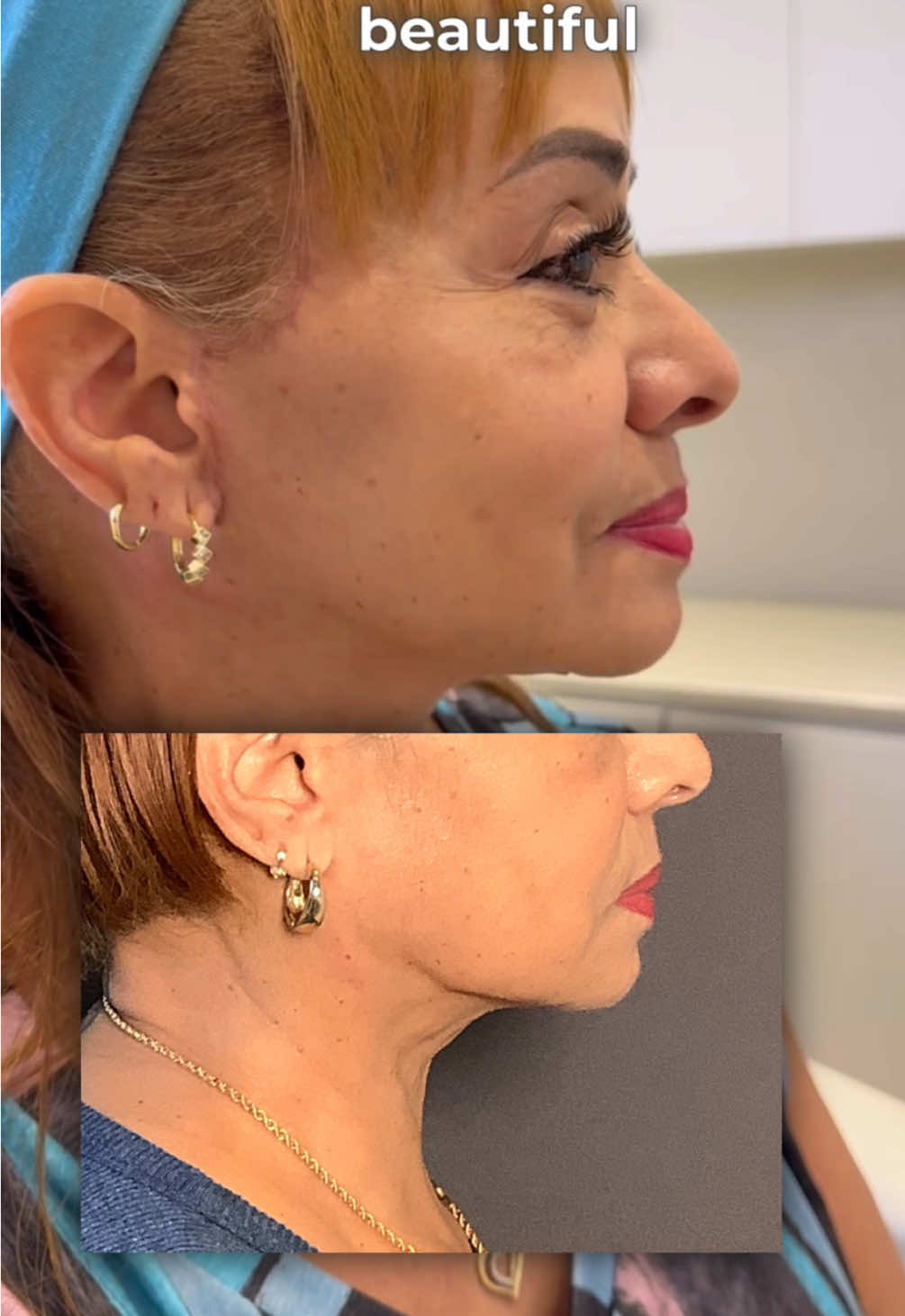 In her own words— everything was an 11/10! 💙 Yesterday’s 57-year-old patient originally came to us wanting a natural, refreshed look without changing who she is. With a customized facelift & neck lift combined with facial fat transfer, we restored youthful contours, smoothed the jawline, and brought back volume where time had taken it away Want to explore all of the effortlessly natural, time-reversing options we have to offer? Consult with us today! 📞 (212)-203-8623 💻 www.albertplasticsurgery.com 📍 950 Park Avenue, New York, NY  #facelift #nyc #necklift #facialfattransfer #plasticsurgery 
