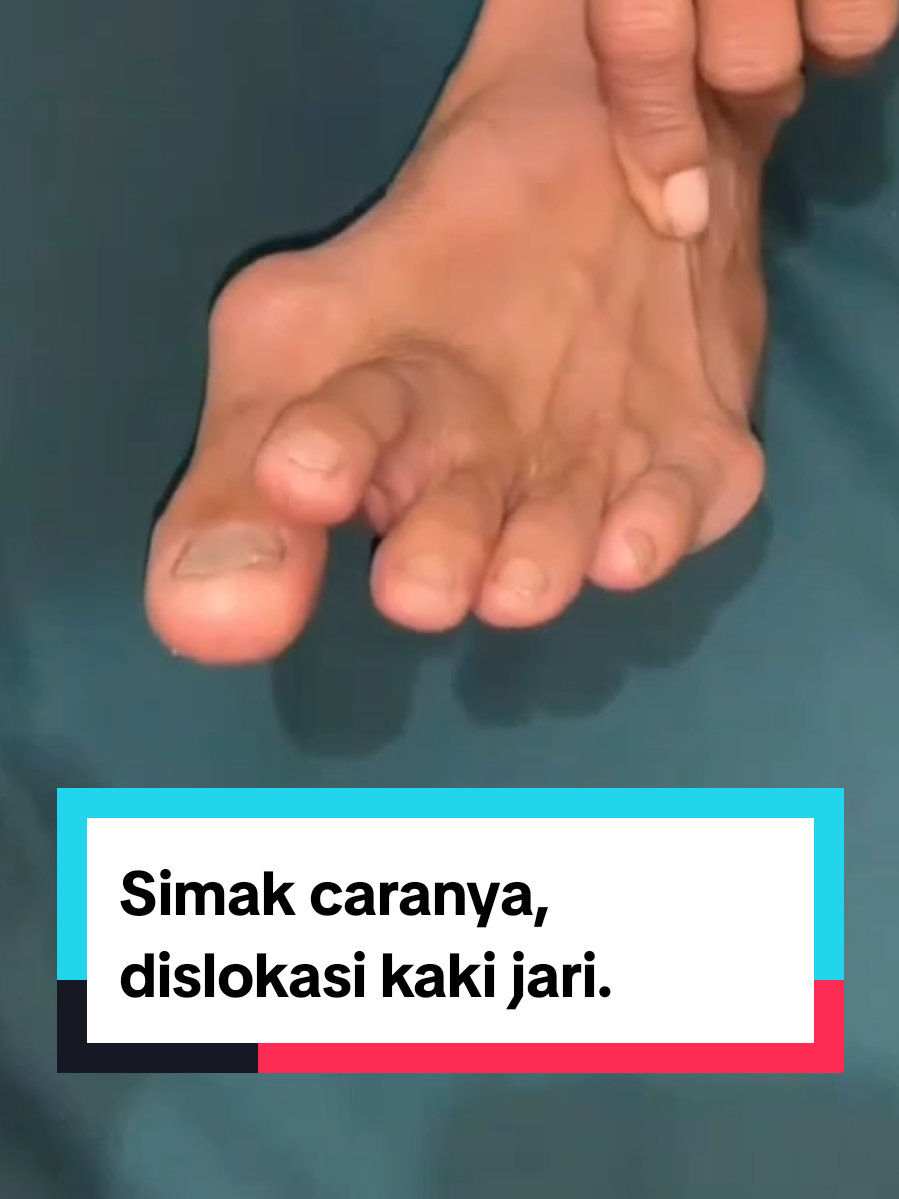 simak caranya.. penanganan kasus pada dislokasi kaki jari, Alhamdulillah langsung kembali keposisinya.. dengan teknik dan metode neo sangkal putung secara tradisional. InsyAlloh sangat membantu mengatasi kasus kasus cidera tulang.. yuk pelajari dan pahami ilmunya..cek dlink bio.. . . . #sangkalputung #dislokasisendi #patahtulang #keseleo #terkilir #cideratulang #tulangpatah #viral #pengobatan #tradiosonal #acl #dislokasi #tiktok #fyp #bsp #pengobatantradiosonal #pengikut #sorotan #sangkalputungbudi #tulangpatah #tulangbengkok #yanmu #kaderyanmu #intiraga
