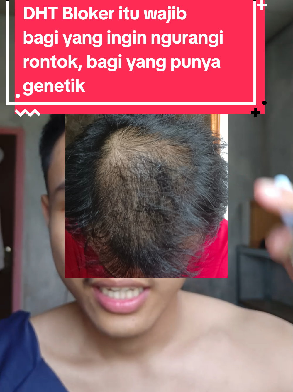 dht bloker alami peyton hue  #peytonhue #haircarealami #rosemaryoil #HairCareTips #dhtblocker 
