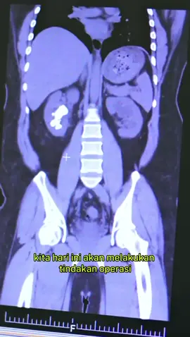 Hari ini kami akan melakukan tindakan operasi pada seorang pasien laki-laki berusia 31 tahun yang didiagnosis mengalami staghorn stone atau batu cetak di ginjal kanan. Disebut “batu cetak” karena batu tersebut bentuknya mengikuti lekukan sistem pengumpul urine di dalam ginjal, sehingga terlihat seperti tercetak di organ tersebut. Untuk penanganannya, kami akan melakukan prosedur PCNL (Percutaneous Nephrolithotomy). Pada prosedur ini, kami akan membuat sayatan kecil (sekitar 1 cm) di area pinggang pasien, lalu memasukkan kamera dan alat khusus langsung menuju lokasi batu di dalam ginjal. Melalui prosedur ini, ukuran batunya mencapai kurang lebih 5 cm. Dengan pendekatan PCNL, pasien diharapkan dapat pulih lebih cepat, dan dapat memberikan kesehatan buat pasien. Next video selanjutnya saya yang akan menunjukkan proses operasinya! ✨ #UrologyExpert #PCNL #BatuGinjal #EdukasiKesehatan #GinjalSehat