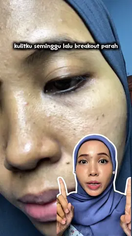 Kalo gamau kulitmu breakout parah ganti pake ini  #SkincareKorea #SpringOrigin 