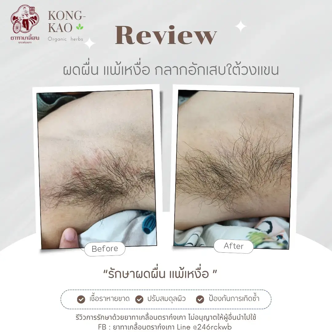 💢 ร้อน เหงื่อออกทีไร...คัน แสบ เป็นผื่นทุกที! ใต้วงแขนมี กลาก-ผดผื่นคัน จนเสียความมั่นใจ 😣 💬 ใช้ ยาทาเกลื้อนตราก๋งเกา สูตรสมุนไพรออร์แกนิก 🌿 ช่วยลดอาการคัน แห้งเร็ว หายขาด ไม่ทิ้งรอยดำ ✅ หายคันตั้งแต่ครั้งแรก ✅ ผื่น-กลากยุบไว ✅ ปลอดภัย ไร้สารสเตียรอยด์ #แพ้เหงื่อ #ผดผื่นคัน #กลากใต้วงแขน #ยาทาเกลื้อนตราก๋งเกา #ยากำลังเถา 