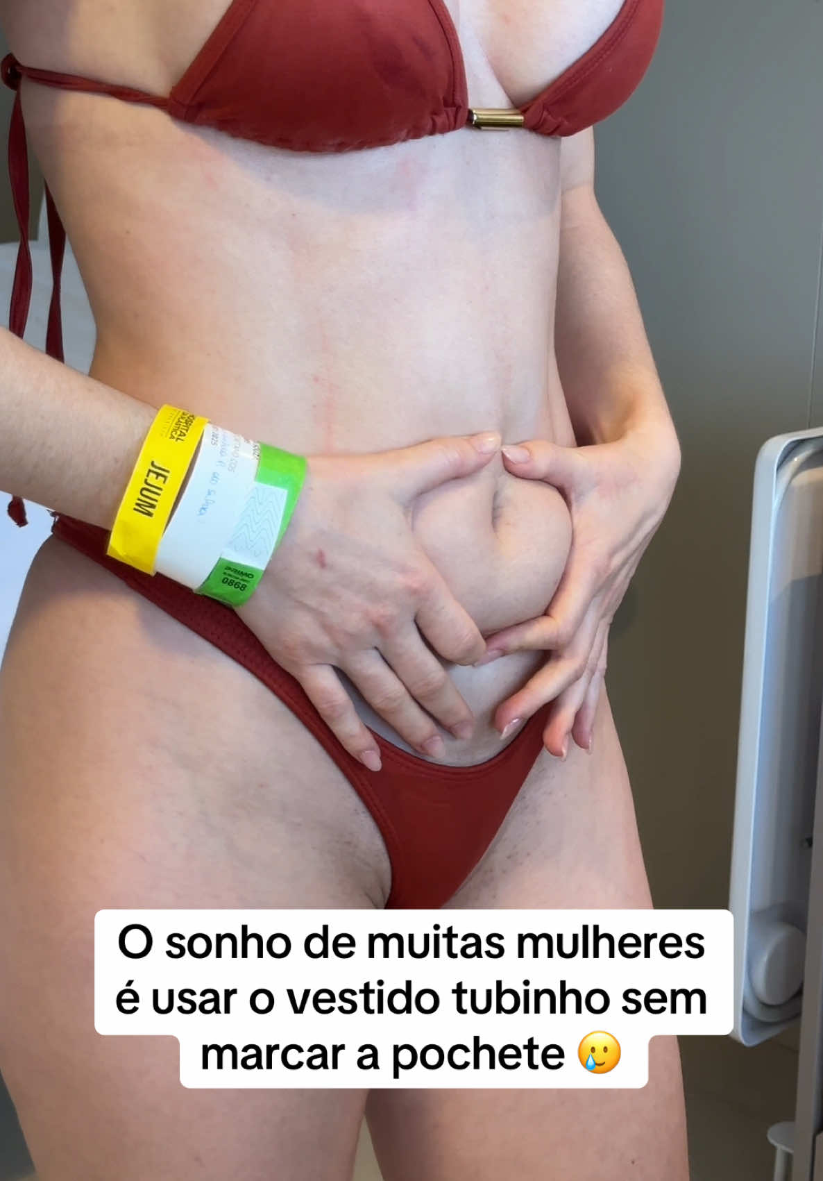 Quando eu falo que lipo é para melhorar o corpo que já está bom, é por isso. Ela se incomodava com a pochete que marcava em roupas mais justas, e resolvemos com uma lipo de abdômen e flancos.  #lipohd #lipo #lipoescultura #antesedepoislipo 