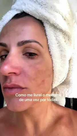 Pesquisem pelo método da cosmetóloga Roseli Siqueira, foi a partir dele que me curei do melasma.  #melasma #skincare #manchasnapele  ♥️