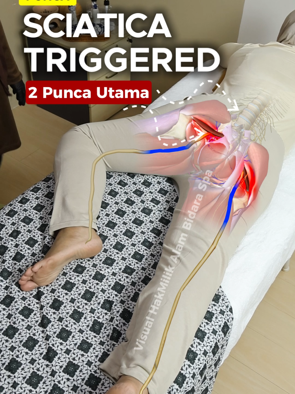 berSauna bantu banyak masa proses urutan sbb saraf akan jadi lembut. So urutan akan jadi lebih lancar dan bantu boost pemulihan semulajadi. Sebab saraf sciatic ni paling kenyal + panjang + paling besar (± saiz jari kelingking) #sciatica #periformissyndrome #sarafsciatica 