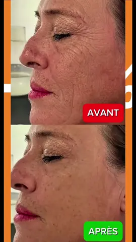 Le résultat est juste fou #antiaging 