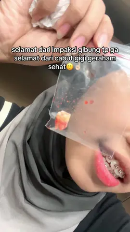 bener kata orang, walaupun bayar mahal sampe 1,5jt tp ada harga ada kualitas coy. pas dicabut ga sakit samsek, after 2jam cenat cenut tp langsung minum obat udh ga sakit lagi😭💸 kuncinya adalah duit guys😇💸 #behel #behelgigi #behelstory #beheljourney #fyp 