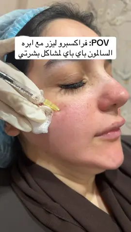 دمج الفراكسبرو مع ابرة السالمون والخلايا الجذعية من اقوى أنواع الدمج لاعاده نضاره الجلد ومعالجة سبع مشاكل منها التصبغات والندبات والحفر والمسامات والبهتان والخطوط السطحية والتشققات الجلدية  لا يفوتكم عروض الصباح  #تفتيح_البشرة #عيادات_تجميل #فراكسبرو #النضارة_السباعية #ultraformer 